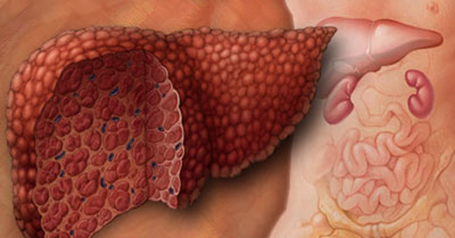 Увеличение желчного пузыря при гепатите thumbnail