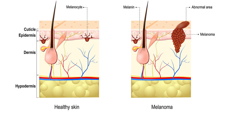 ОПАСНЫЕ РОДИНКИ: 6 признаков меланомы