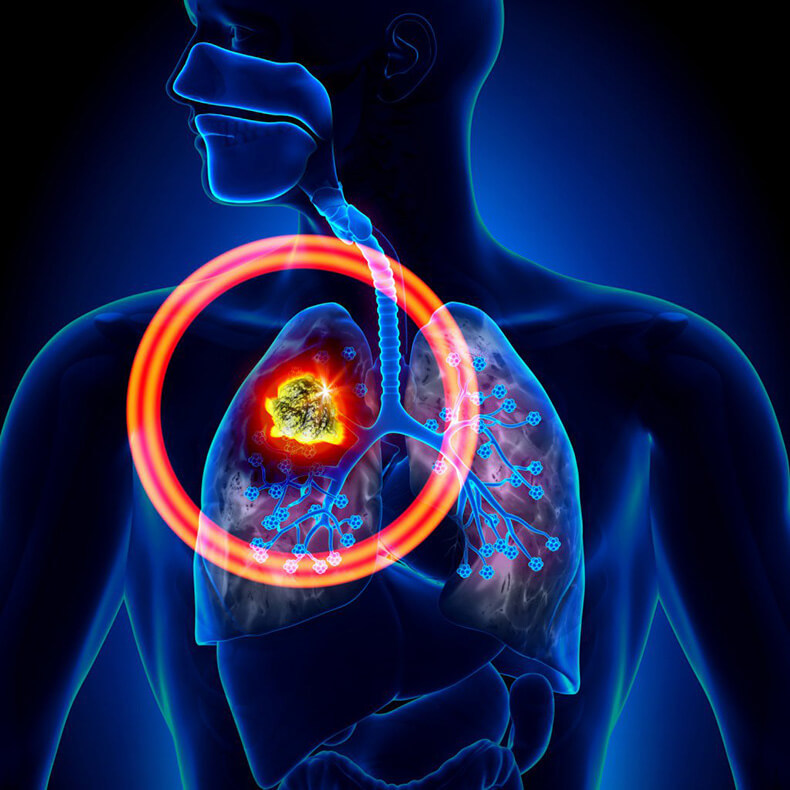 Может ли быть рак легких без кашля и температуры thumbnail