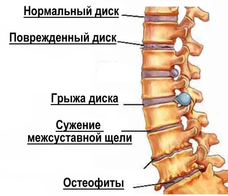 Цервикокраниалгия на фоне шейного остеохондроза