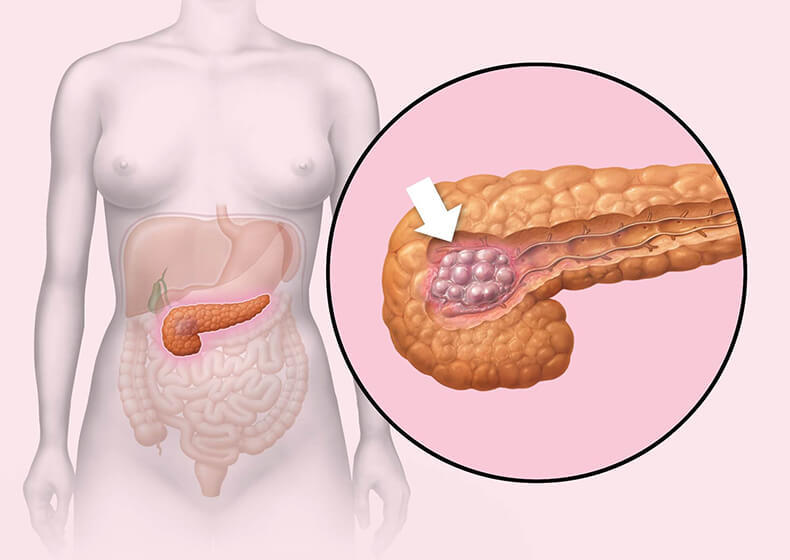 Стеатоз поджелудочной железы: Что делать, если железа начинает перерождаться в жир