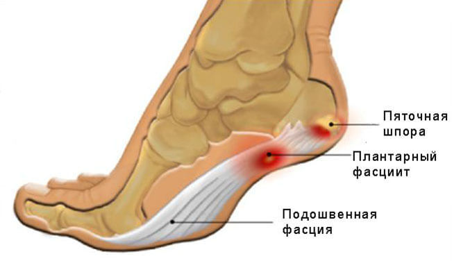 Плантарный фасциит стопы картинки