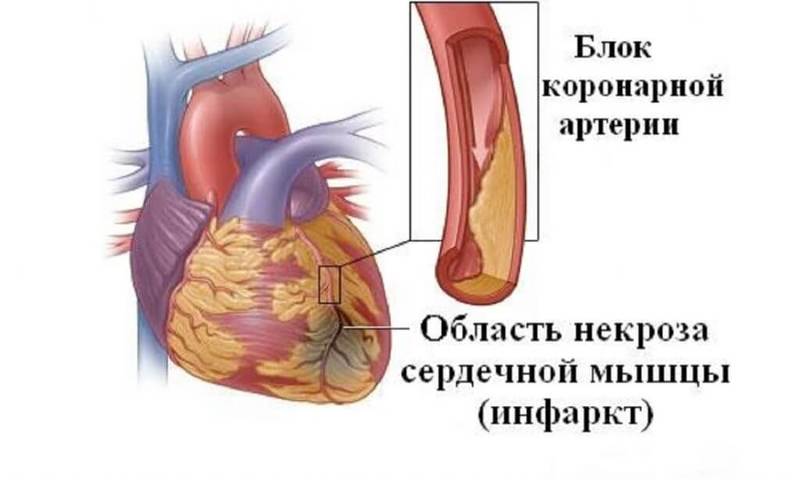Как определить инфаркт у мужчин и женщин