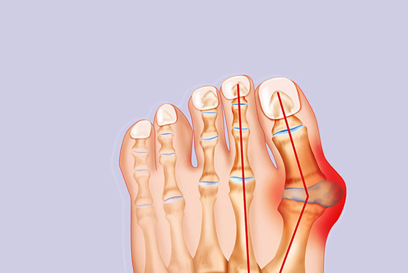 «Косточки» на ногах: Советы врача-остеопата