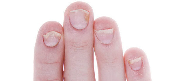 10 вещей, которые расскажут ногти о вашем здоровье