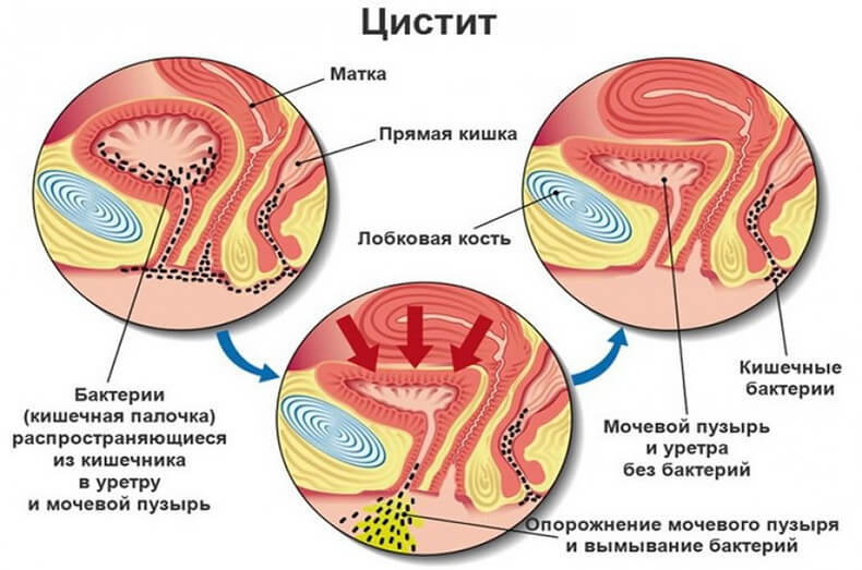 Доктор Евдокименко: Как вылечить цистит за 1 день – без таблеток и антибиотиков