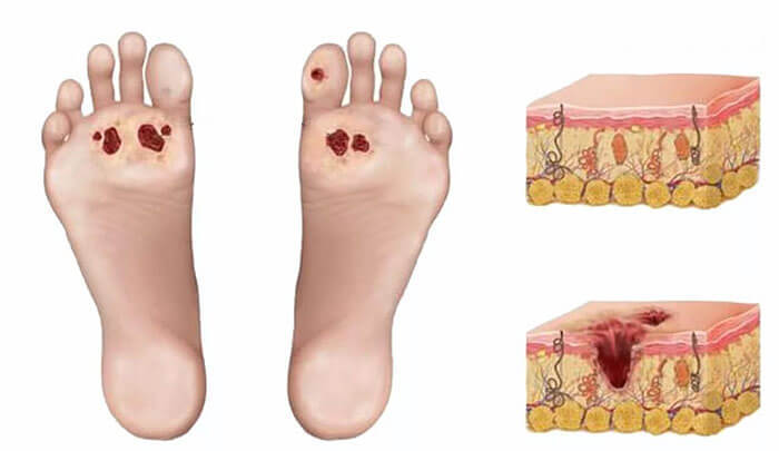 Гниют ноги симптомы и лечение thumbnail