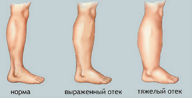 Кривые ноги фото
