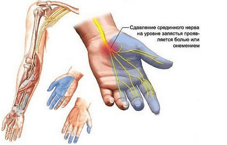 Упражнения для кистей рук при карпальном синдроме thumbnail