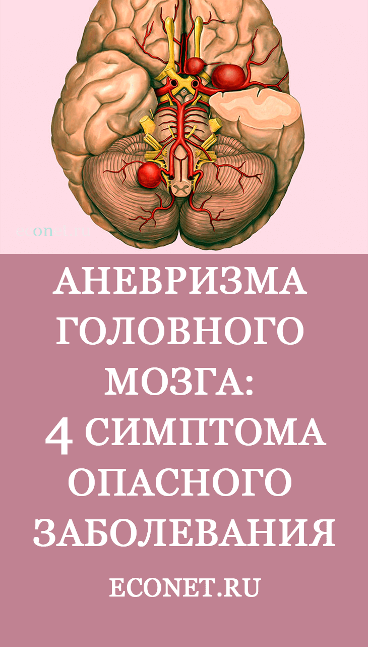 Аневризма головного мозга: 4 симптома смертельно опасного заболевания ...