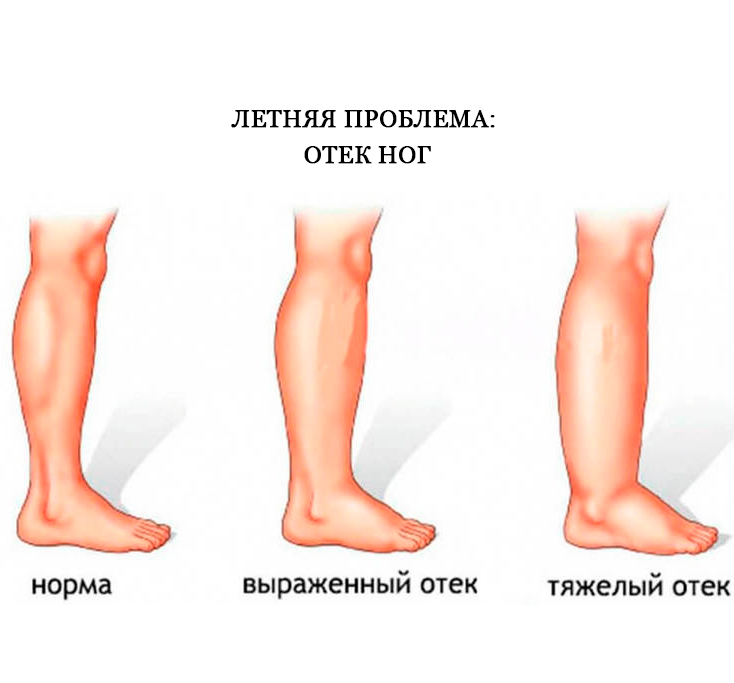 Что делать если ноги опухли от цемента