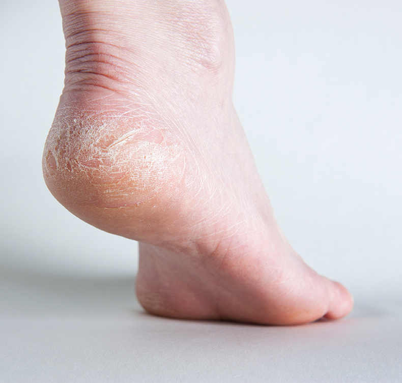 18 признаков плохого здоровья, о которых расскажут ваши ступни