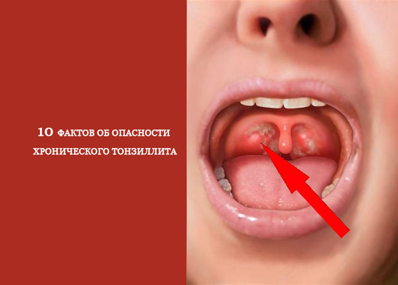 10 фактов об опасности хронического тонзиллита | Здоровье | Селдон Новости