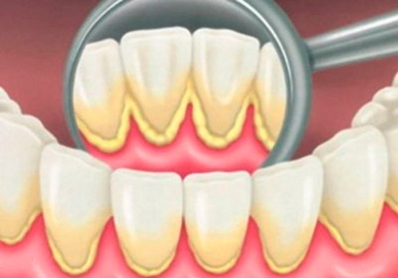 12 советов, которые помогут предупредить образование зубного камня