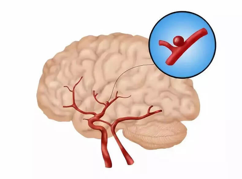 Аневризма сосудов головного мозга симптомы причины