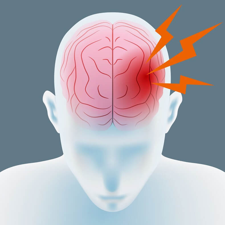 Аневризма сосуда головного мозга: 4 признака, которые должен знать каждый 