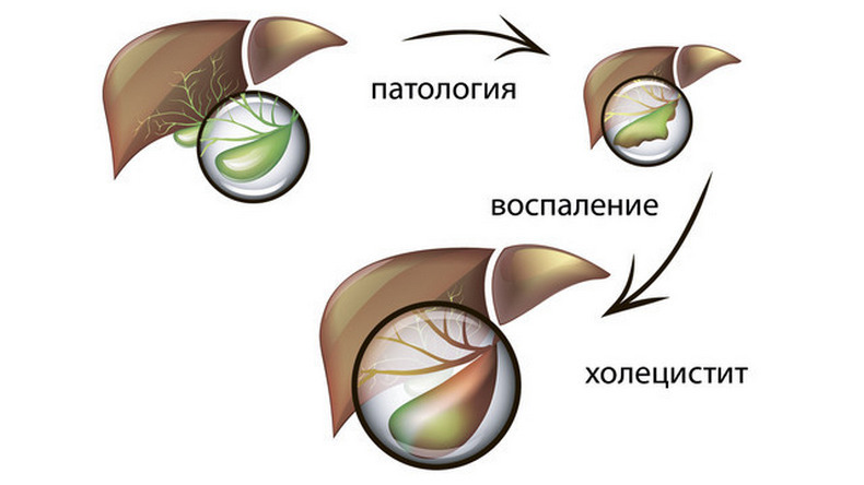 Характер стула при холецистите