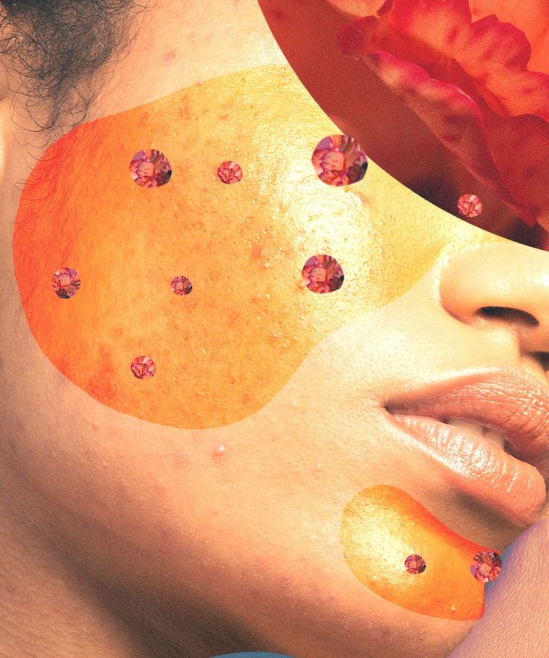 Розацеа на лице: Средства, которые помогут снять покраснение и зуд 