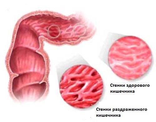 Синдром раздраженного кишечника стул