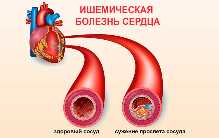 Клиническая картина ишемической болезни сердца