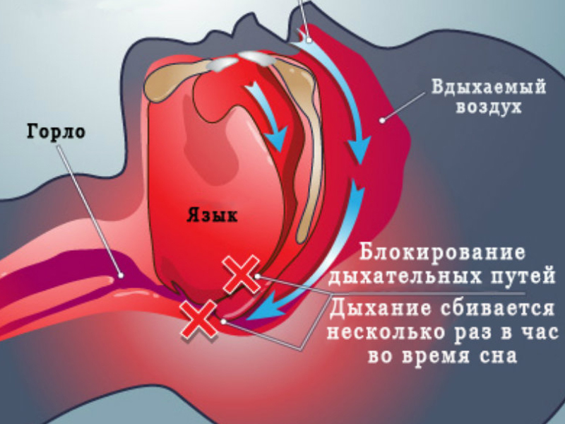 Какие есть гаджеты от храпа