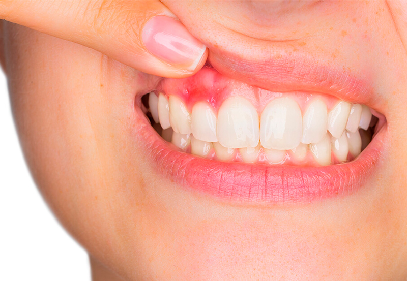 Что важно знать про зубные импланты