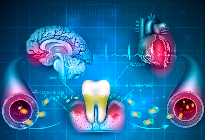 Пародонтоз: Как решить проблему самостоятельно