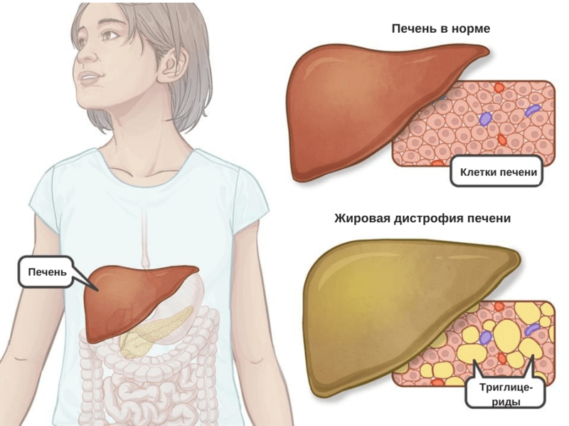 Неалкогольная жировая болезнь печени презентация