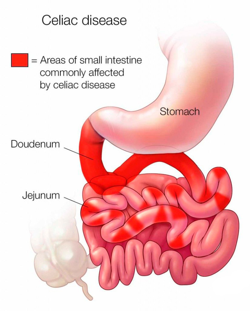 Целиакия: симптомы, риски для здоровья и лечение