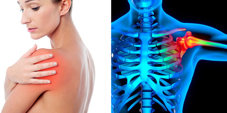 Боль в плече: 7 натуральных средств-помощников