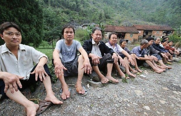 Ученых поставила в тупик болезнь, уродующая деревенских жителей в Китае