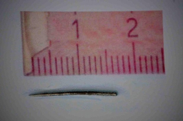 Куръезы—из тела шведа вышла застрявшая 40 лет назад игла от тату-машинки